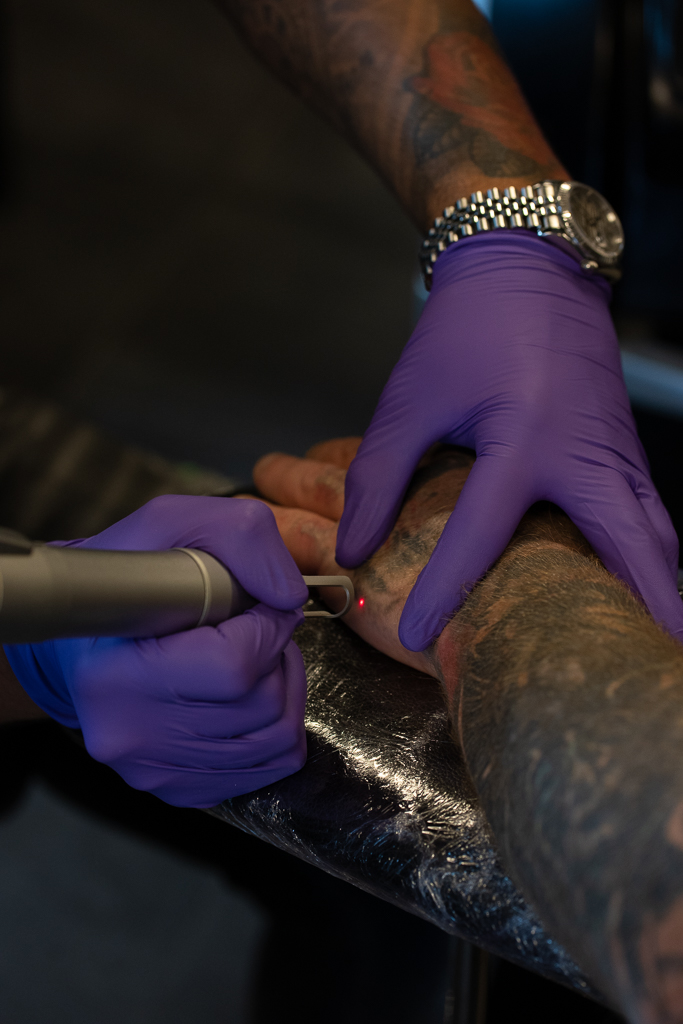 tattoo verwijderen den haag 1 "Een professionele laser tatoeage verwijdering behandeling in actie, met focus op geavanceerde lasertechnologie gericht op het veilig en effectief verwijderen van inkt uit de huid,